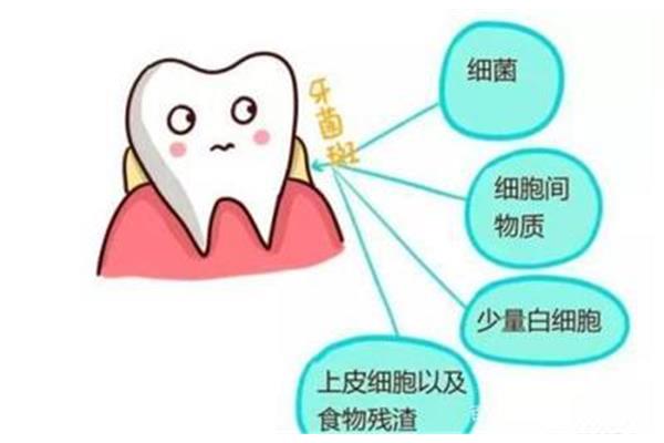 牙菌膜清除