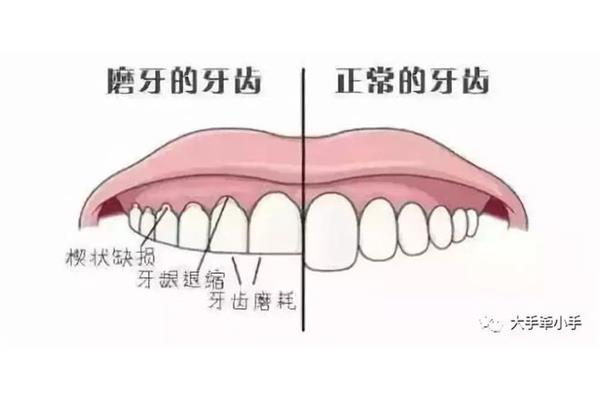磨牙對矯正牙齒的危害(矯正磨牙是什么意思)