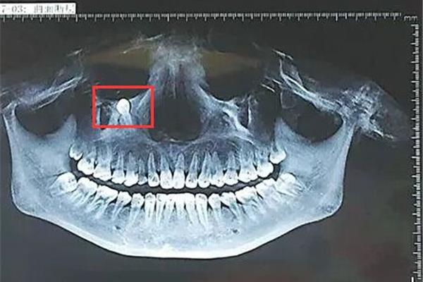 牙齒攝影矯正的問題(什么是埋伏牙)
