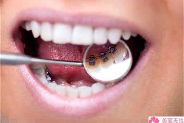 笑的時候露出牙齦可以矯正嗎(笑的時候露出牙齦怎么治療?)