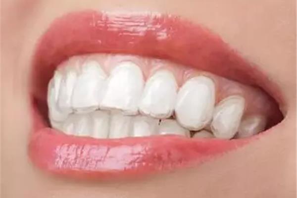 隱形牙套的圖片(隱形牙套有效嗎?)
