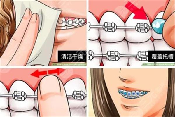 正畸治療后如何清潔固位體?如何用牙套清潔牙齒?