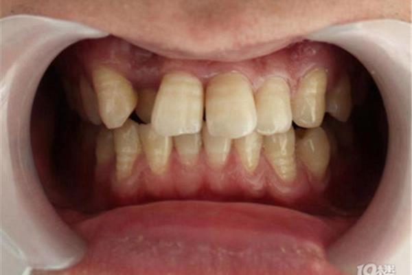 小貓牙齒錯位換牙后能恢復嗎(兒童換牙脫位怎么處理)