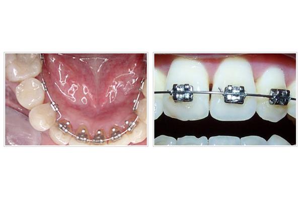 牙齒擴張器擴張的圖片(什么是牙齒擴張器)