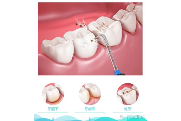 細牙骨可以矯正牙齒嗎(牙套矯正牙齒的過程)