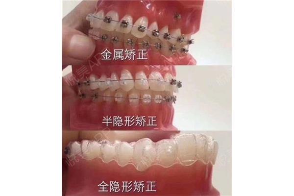 正畸牙套需要戴多久(未成年牙套需要戴多久?)