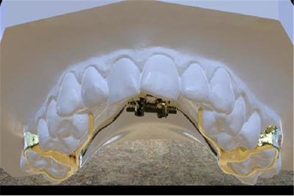 如何制作牙科擴張器(鼻擴張器可以矯正鼻中隔)