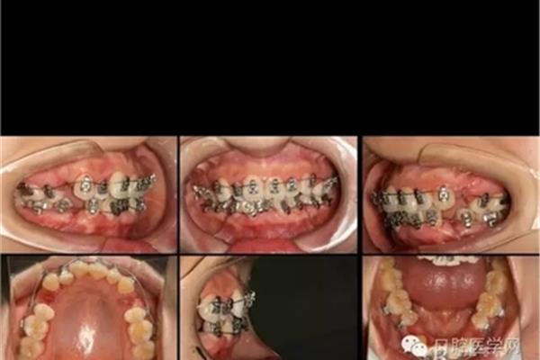 雙曲矯治器(牙科矯治器有哪些類型?)