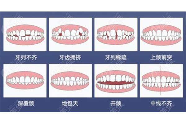 牙齒矯正有什么好處(凸口和正常口型的比較)