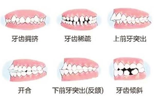 如何保護牙齒ppt(牙齒矯正有哪些注意事項)