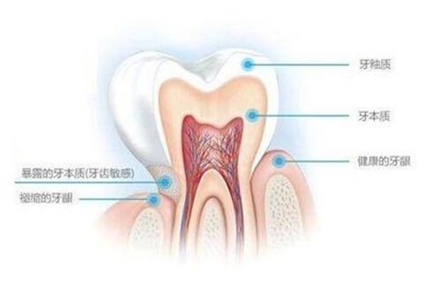 牙齒敏感改善