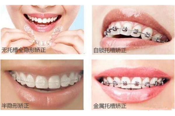 牙齒矯正方法