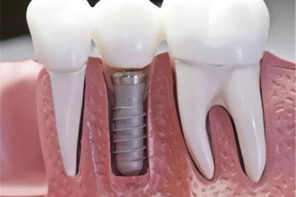 矯正牙齒牙套(哪種牙套矯正牙齒效果更好?)
