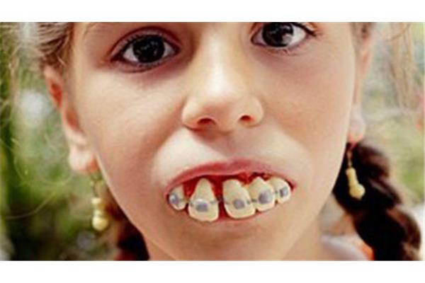 如何矯正孩子的齙牙(矯正孩子的齙牙需要多長時間?)