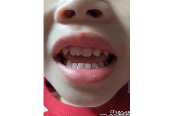乳牙換牙的順序和時間圖(孩子什么時候換牙?)