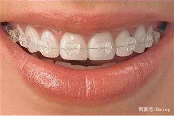 矯正牙齒用什么材料好(牙齒矯正器主要有哪些類型?)