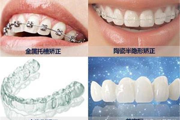 上海隱形牙齒矯正費用(一個隱形牙套多少錢?)
