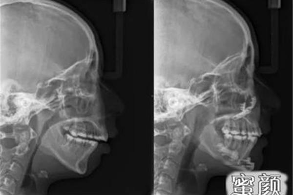 正畸中的關節問題(顳下頜關節和正畸有關系嗎)
