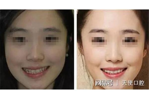 漢字臉矯正牙齒改變臉型(正畸對臉型的改變有多大)