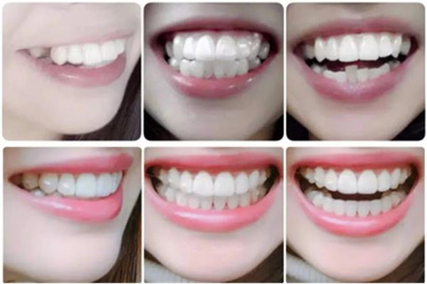 牙齒矯正的流程(牙齒矯正的整個流程有幾個步驟?)