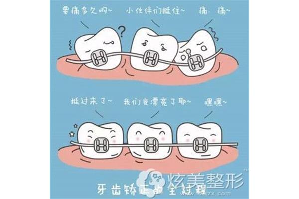 矯正牙齒的牙套原理(牙套怎么做矯正牙齒原理)