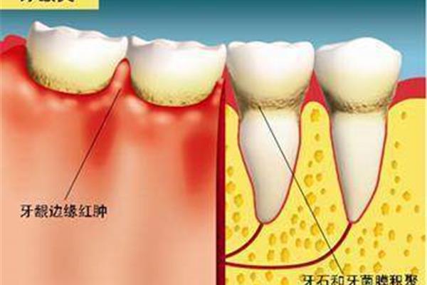 缺鈣對牙齒有什么影響?如何應對(孩子換牙需要補鈣嗎)