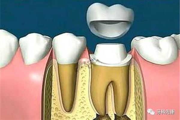 營養與牙周病的關系(營養因素對牙周病的影響)