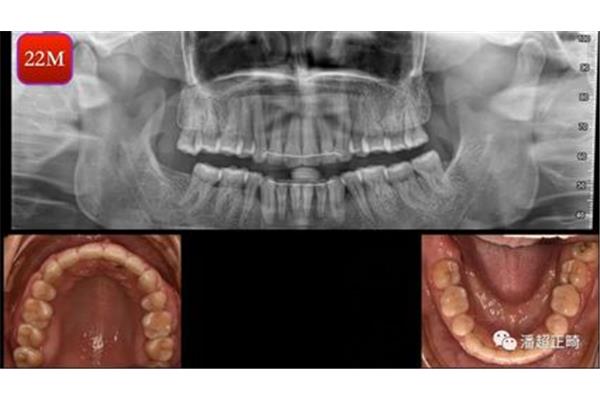 什么是骨性齙牙?(骨性齙牙矯正前后?)
