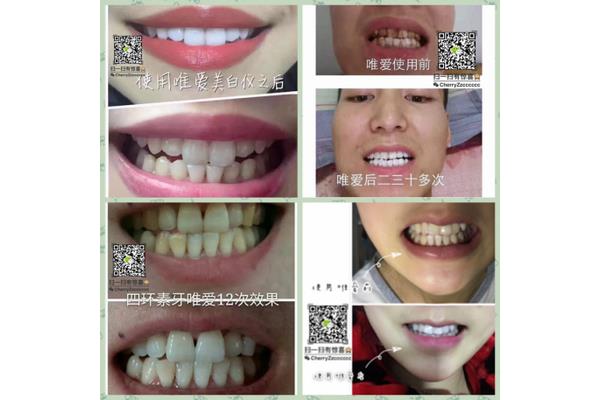 牙科安裝牙套過程(打樁牙套過程)